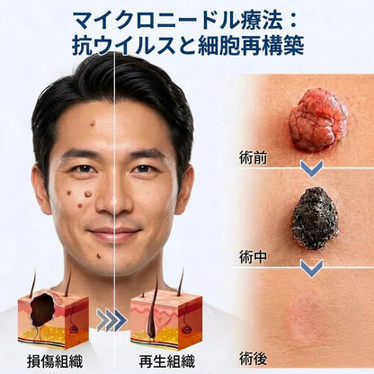 ✨✨DR.Fachmer® 2-in-1 マイクロニードル＆ハイドロコロイドパッチ🍀| 盛り上がったホクロ・ニキビ・扁平イボ・スキンタッグのケアに | シワ・ニキビ跡・肌の色ムラをケア | 目立たない透明パッチ（顔・体用）