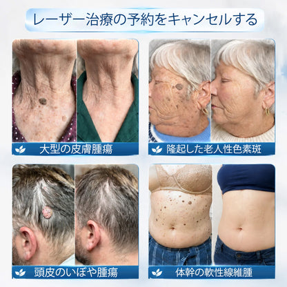 公式ショップ ✅｜Rolimey® 7日間集中ケア 肌のイボ・角質粒・シミのような色ムラケアに特化した美容パッチ👩‍⚕️ （痛みなし・傷跡なし・正確に塗布できるロールオンアプリケーター）🔥