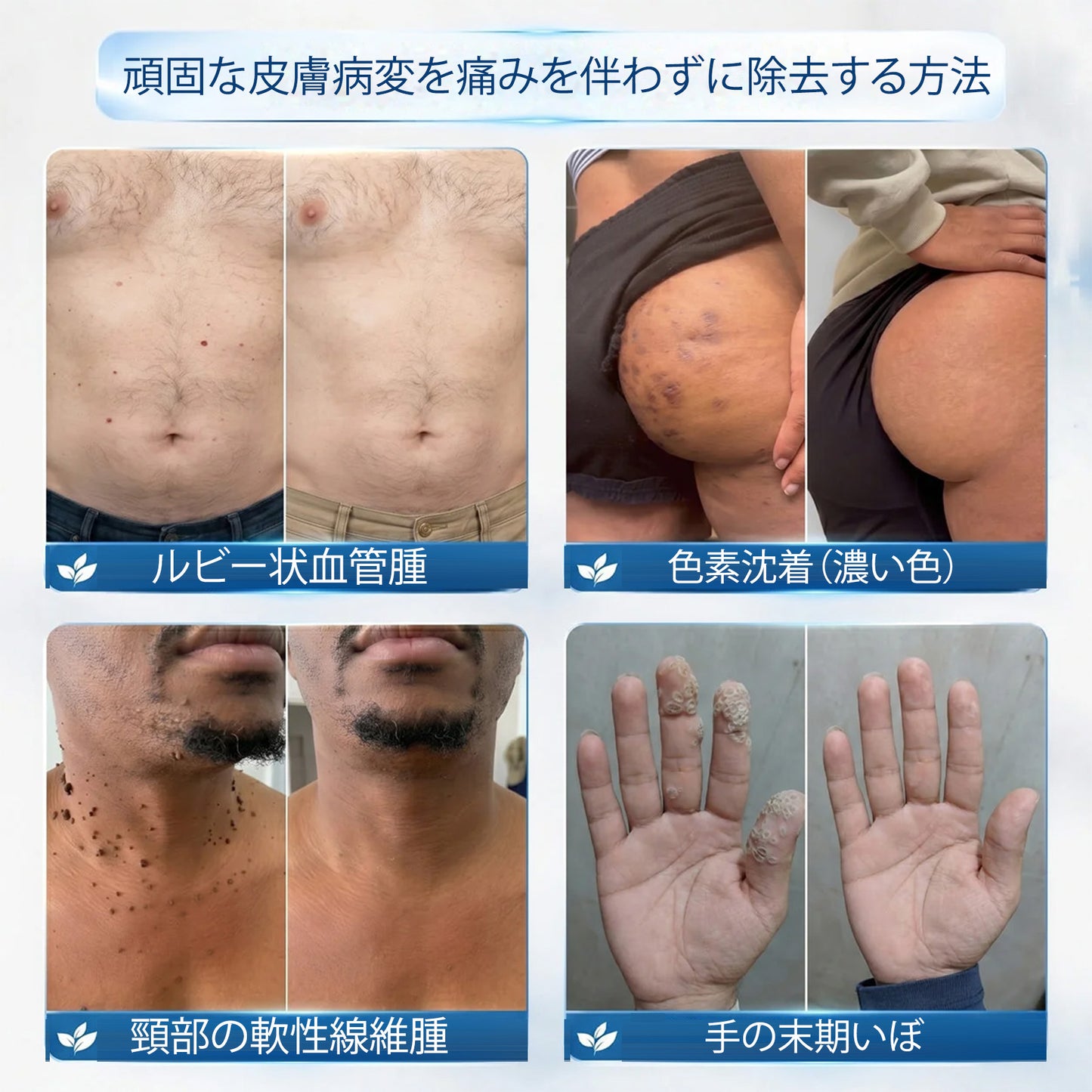 公式ショップ ✅｜Rolimey® 7日間集中ケア 肌のイボ・角質粒・シミのような色ムラケアに特化した美容パッチ👩‍⚕️ （痛みなし・傷跡なし・正確に塗布できるロールオンアプリケーター）🔥
