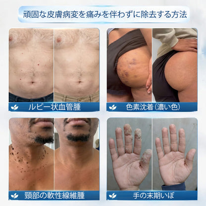 公式ショップ ✅｜Rolimey® 7日間集中ケア 肌のイボ・角質粒・シミのような色ムラケアに特化した美容パッチ👩‍⚕️ （痛みなし・傷跡なし・正確に塗布できるロールオンアプリケーター）🔥